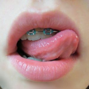 Braces Porn Gifs and Pics - MyTeenWebcam